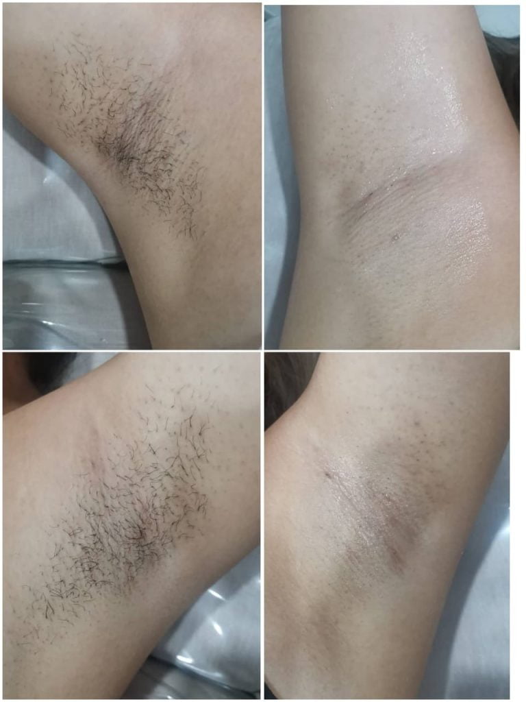 significantly reduced hair growth after 3 treatments of Waxnique's laser hair removal service